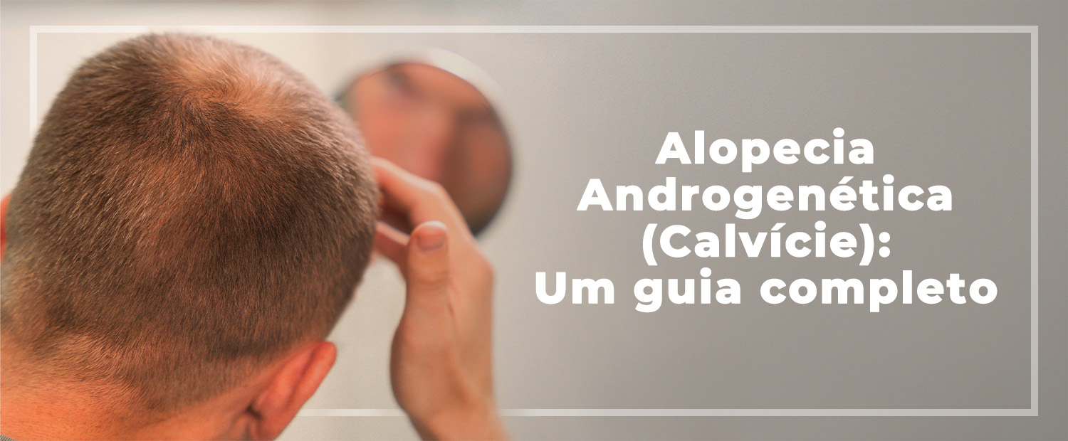 Alopecia Androgenética